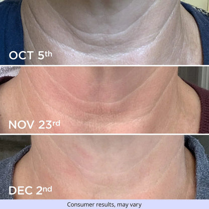 Neck Cream – Firming & Lifting Solution for Crepey Skin